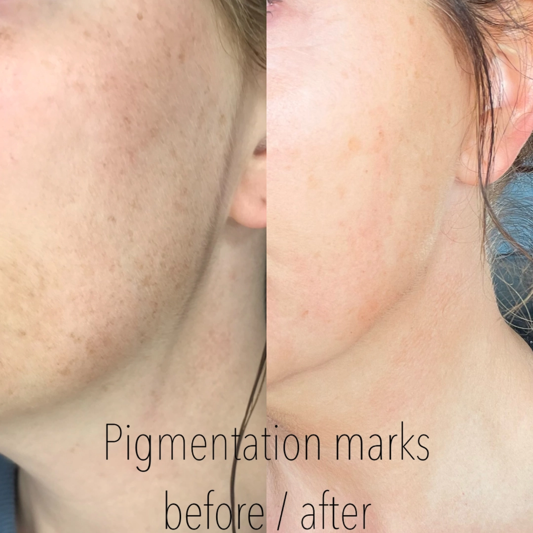 plasma-pen-post-treatment-pigmentation-marks