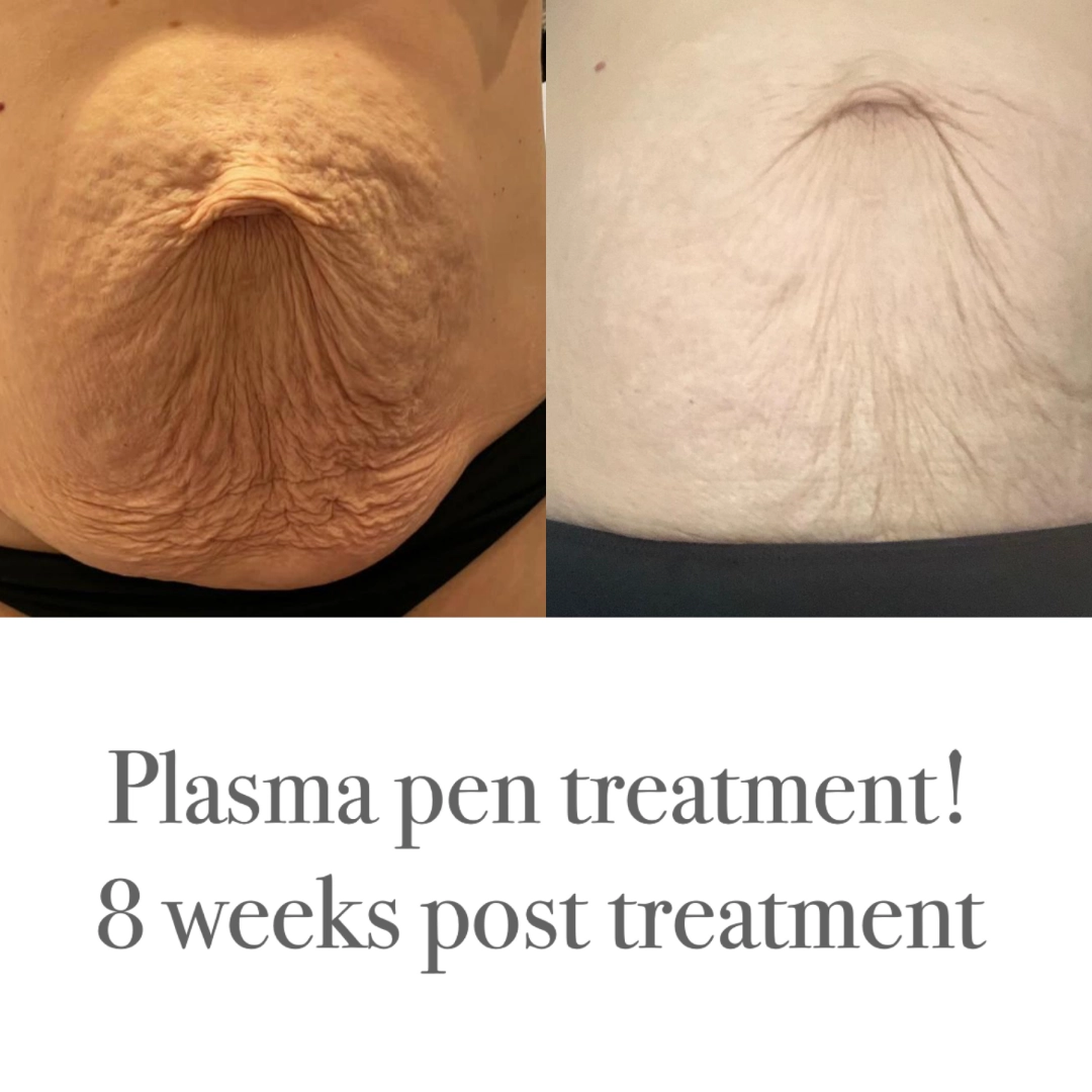 plasma-pen-post-treatment